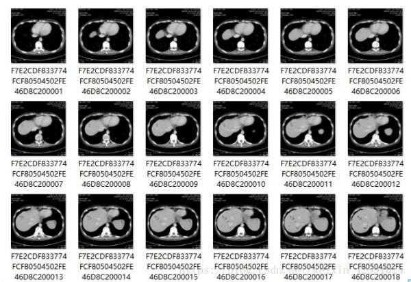 MicroDicom viewer(Dicom格式看圖軟件)